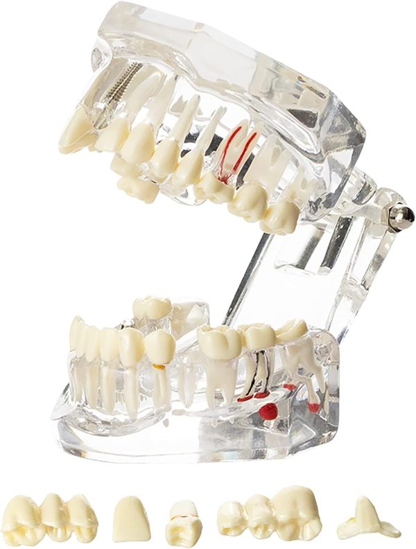 Dental Implant Teeth Model Study Teach Standard Model with Removable Teeth