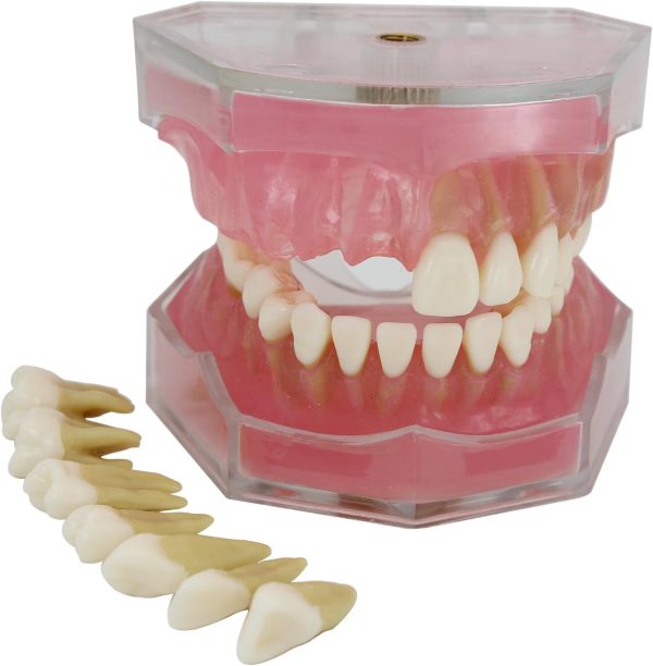 Dental Implant Teeth Model Study Teach Standard Model with Removable Teeth